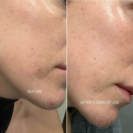 MASQMAI SOS Drying lotion lokali priemonė spuogams 2
